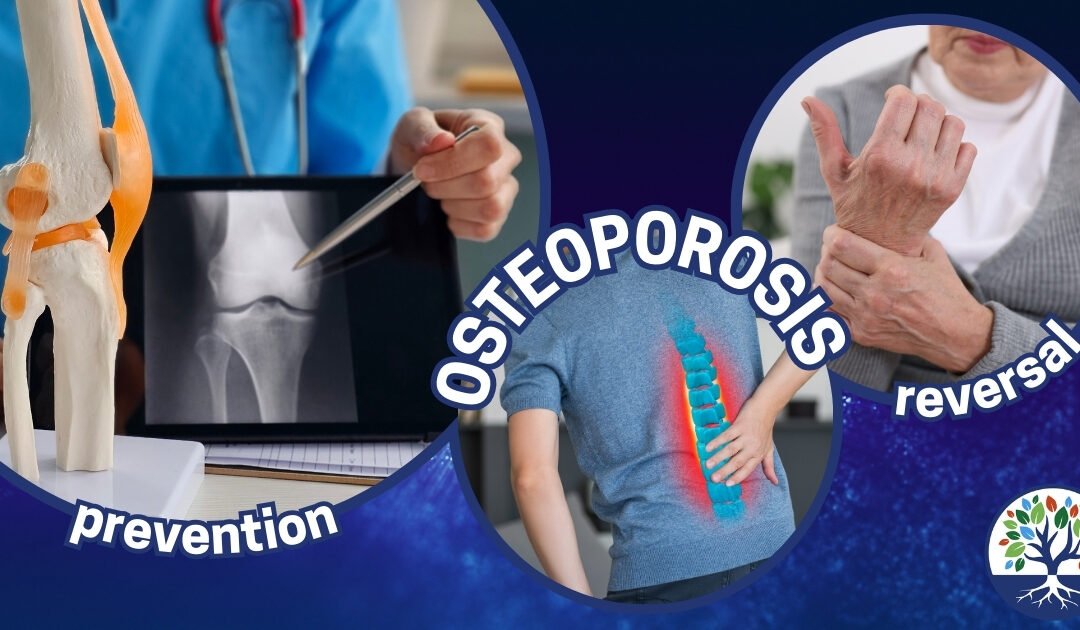 Osteoporosis – A Functional Medicine Approach