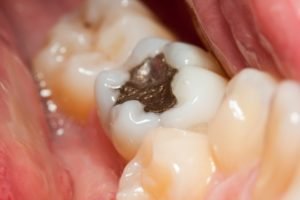 Can Mercury Fillings Make You Sick?
