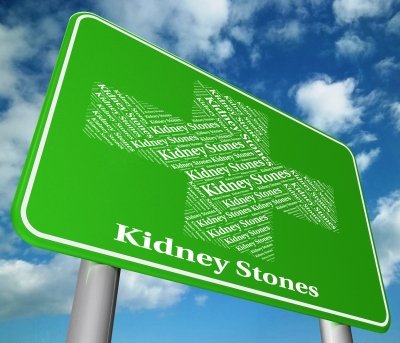 Kidney stones