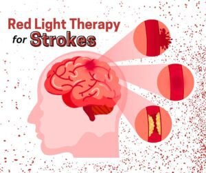 5 Ways Red Light helps Stroke Recovery