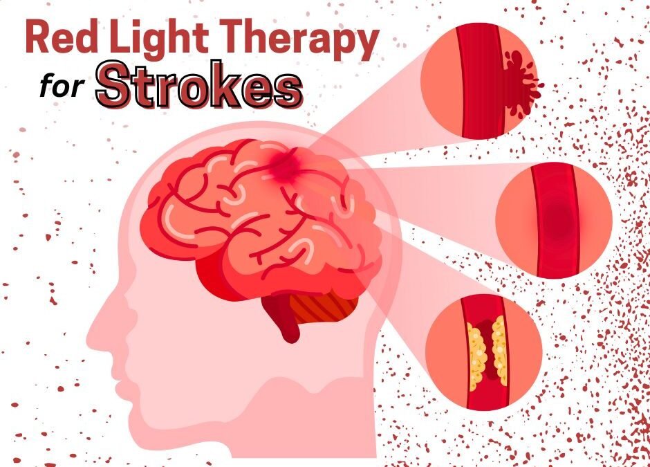 5 Ways Red Light helps Stroke Recovery